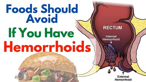 Does Spicy Food Make Hemorrhoids Worse? And Why Do We Keep Eating It Anyway?